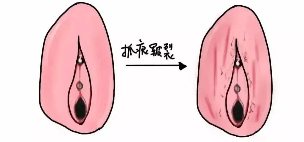 怎样判断自己得了外阴白斑