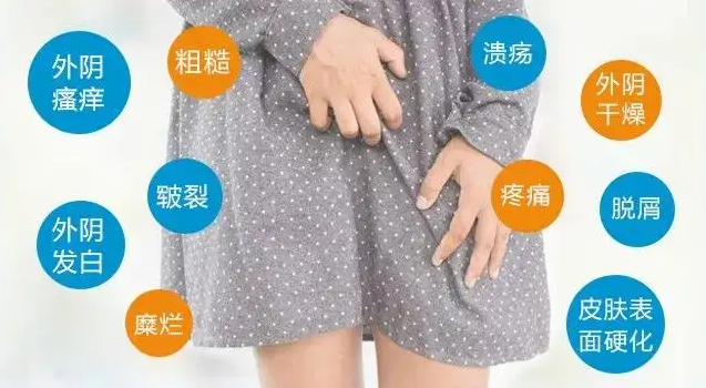 外阴白斑扩散信号