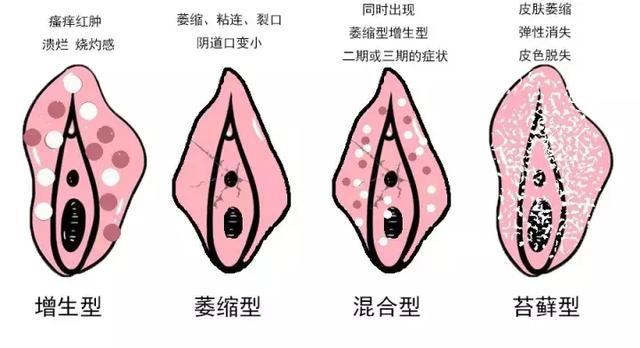 外阴白斑所引起的哪些危害影响比较大?