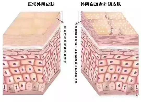 得了外阴白斑会自己好起来吗？