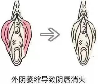 患上外阴白斑后外阴皮肤都有哪些变化?