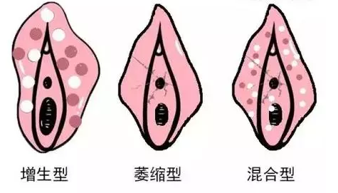 外阴白斑的症状有哪些?