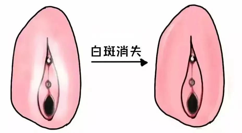 外阴白斑患者如何快速复色?