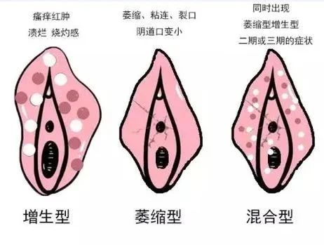 外阴出现瘙痒是外阴湿疹还是外阴白斑?