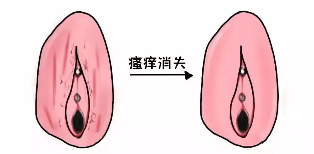 外阴白斑治愈的标准