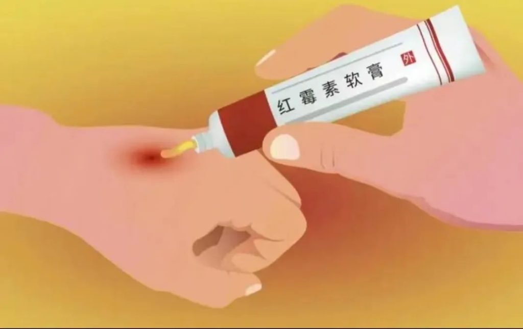 红霉素软膏可以治疗外阴白斑吗?