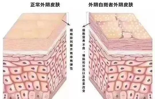 夏季外阴白斑患者日常饮食应该注意些什么?