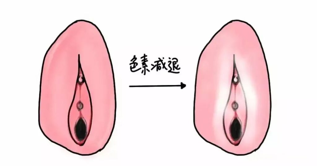 如何避免外阴白斑病情加重?