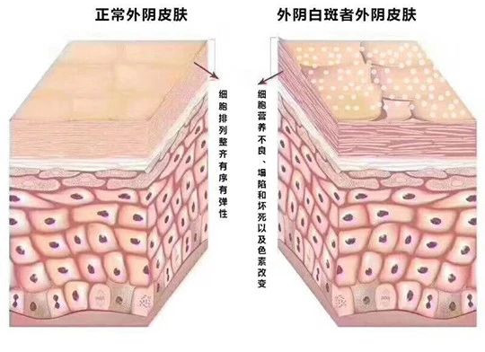 外阴白斑好转的迹象都有哪些?