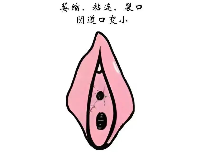 患上外阴白斑后外阴皮肤都有哪些变化?