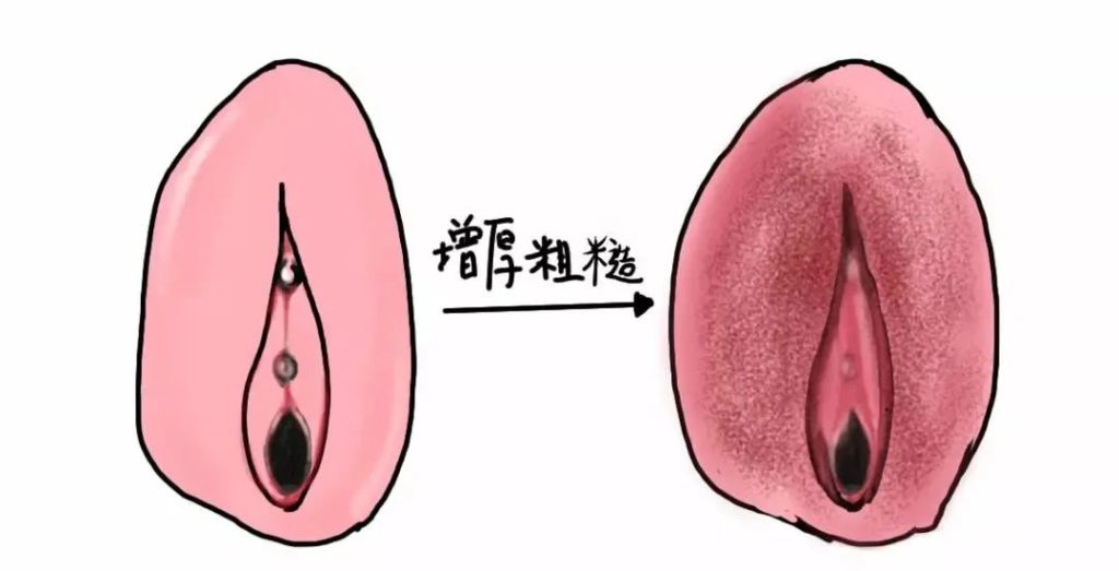 外阴白斑疾病怎么自测？
