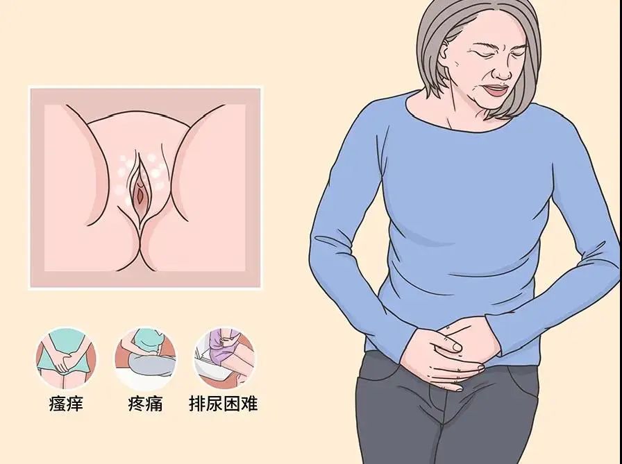 患上外阴白斑后有什么症状表现