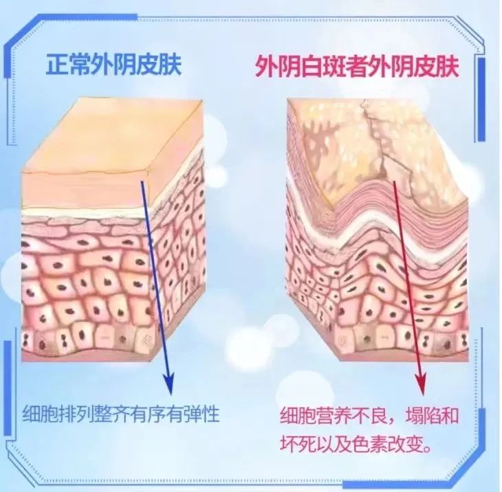 微循环又是如何导致外阴白斑疾病的?